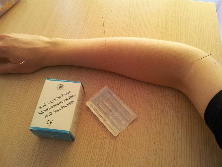 Everything You Need To Know About Acupuncture