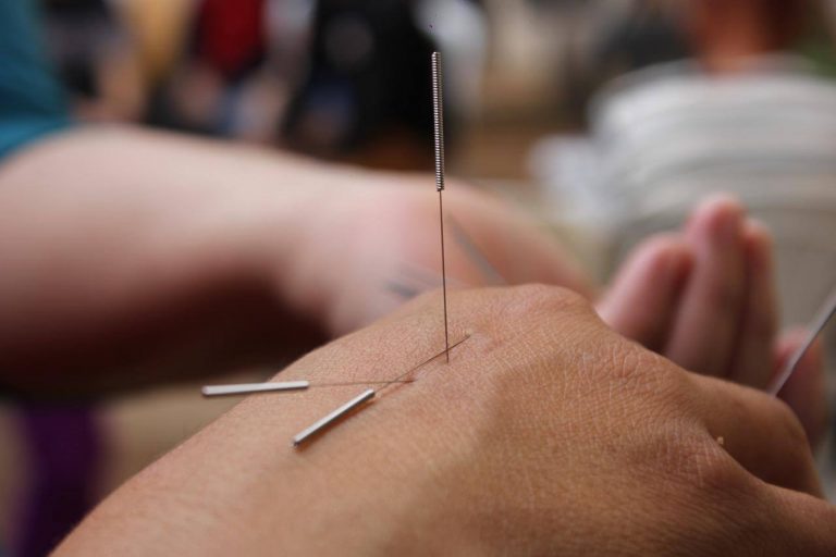 Acupuncture Tips And Tricks Everyone Should Know