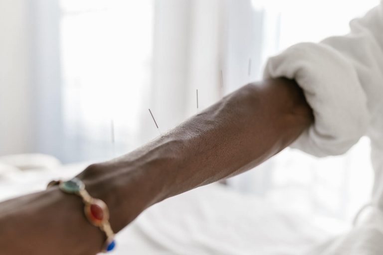 What Acupuncture Is For And How It Can Help
